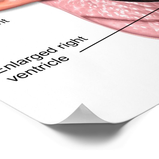 Poster für pulmonale Hypertonie (Ecke)