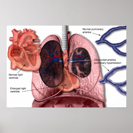 Poster für pulmonale Hypertonie (Vorne)