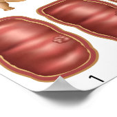 Poster zur Progression des Kolonkarzinoms (Ecke)