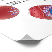 Progression der Lungentuberkulose Poster (Ecke)