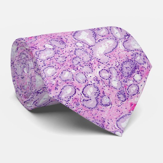 ProstataAdenocarcinoma Krawatte (Gerollt)