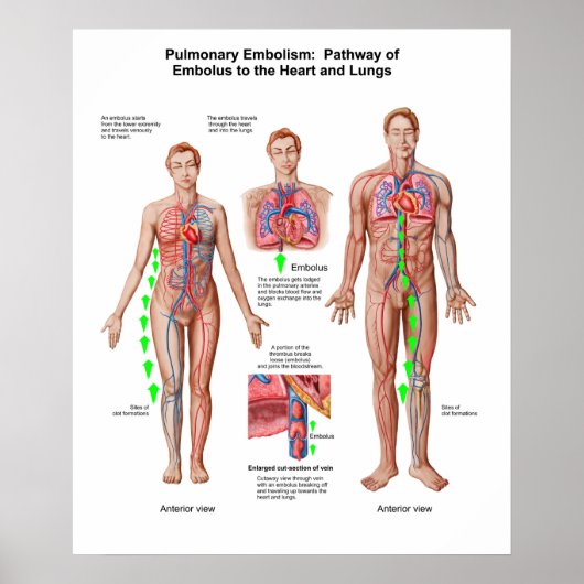 Pulmonary Embolism, Pathway Of Embolus Poster (Vorne)