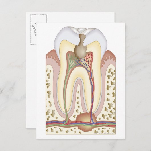 Puls und Wurzelabszess Postkarte (Vorne/Hinten)