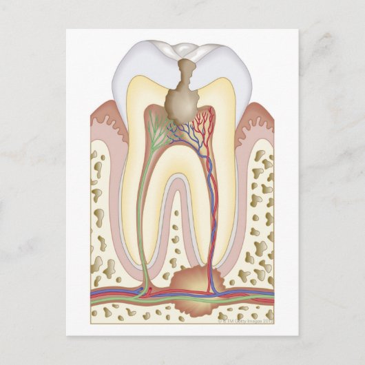 Puls und Wurzelabszess Postkarte (Vorderseite)