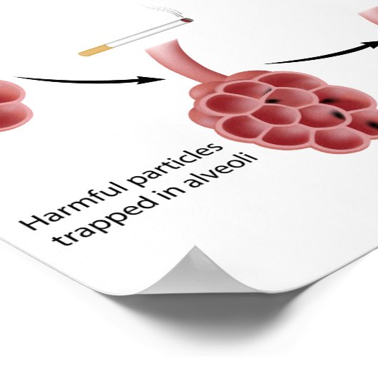 Rauchen und Emphysema Poster (Ecke)