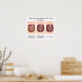 Restorative Proktoktomie mit j-pouch 2 Bühnen Poster (Küche)