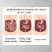 Restorative Proktoktomie mit j-pouch 2 Bühnen Poster (Vorne)