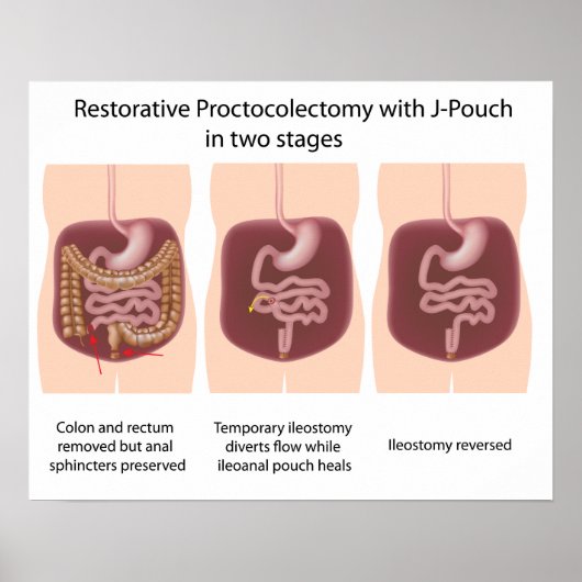 Restorative Proktoktomie mit j-pouch 2 Bühnen Poster (Vorne)