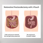 Restorative Proktoktomie-Operation mit j-pouch Poster (Vorne)