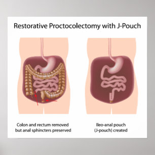 Restorative Proktoktomie-Operation mit j-pouch Poster