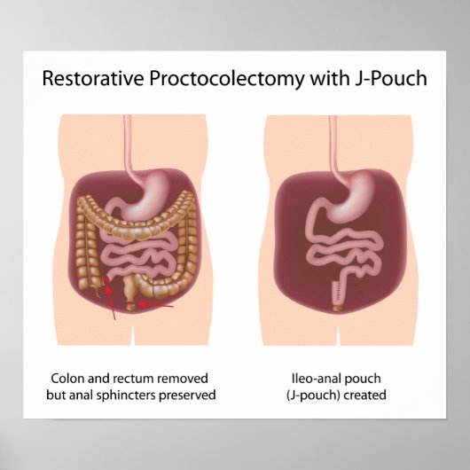 Restorative Proktoktomie-Operation mit j-pouch Poster (Vorne)