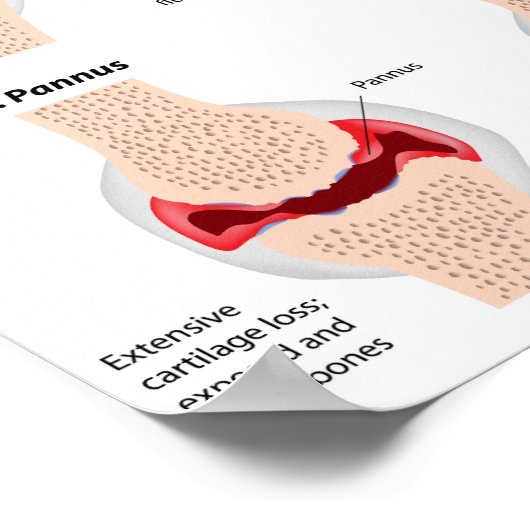 Rheumatoide Arthritis Poster (Ecke)