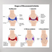 Rheumatoide Arthritis Poster (Vorne)