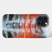 Röntgen-Digitalkunst-Handyhülle iPhone Hülle (Rückseite (Horizontal))