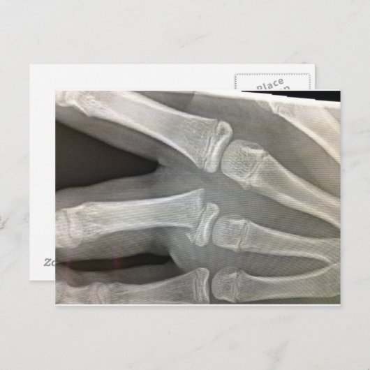 Röntgen-Knochenbrüche werden bald gesund Postkarte (Vorne/Hinten)