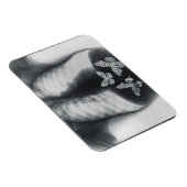 Röntgen von Schmetterlingen im Magen Magnet (Rechte Seite)