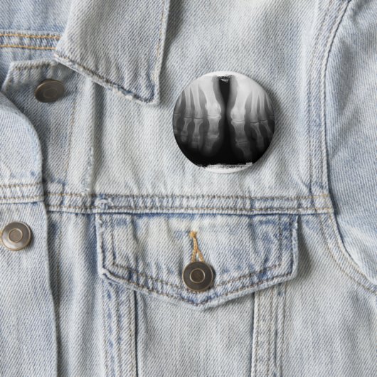 Röntgenstrahl-Fuß-menschliches Skeleton Button (Beispiel)