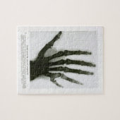 Röntgenstrahl von sechs fingrigem Handpuzzlespiel Puzzle (Horizontal)