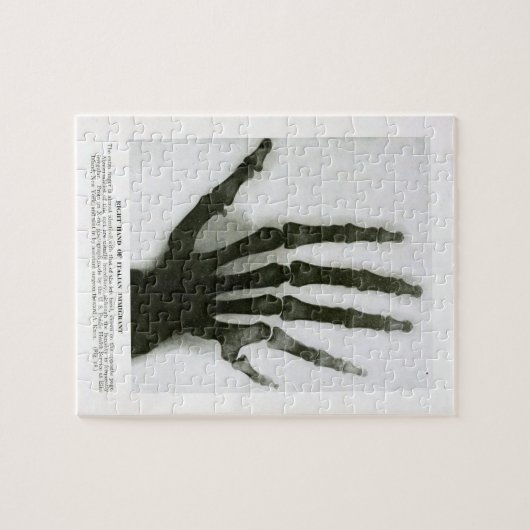 Röntgenstrahl von sechs fingrigem Handpuzzlespiel Puzzle (Horizontal)