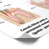 Root Canal Behandlung Poster (Ecke)