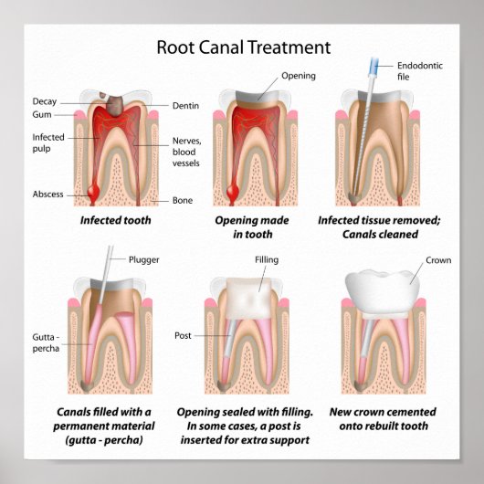 Root Canal Behandlung Poster (Vorne)