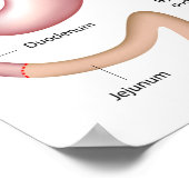 Roux-en-Y Gastric Bypass Operation Poster (Ecke)