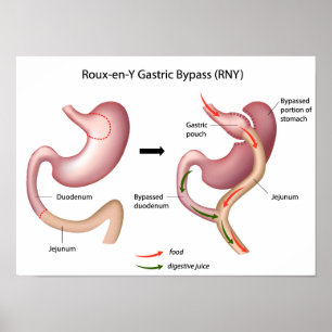 Roux-en-Y Gastric Bypass Operation Poster