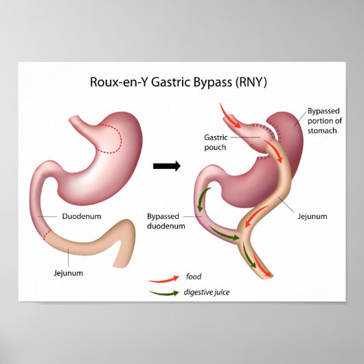 Roux-en-Y Gastric Bypass Operation Poster (Vorne)