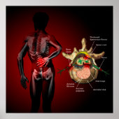 Rückenschmerzen Poster (Vorne)