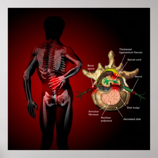 Rückenschmerzen Poster (Vorne)