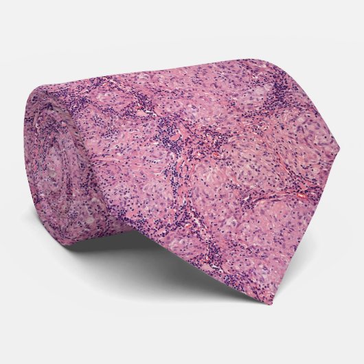 Sarkoidosis Krawatte (Gerollt)