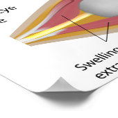 Schilddrüsenaugenerkrankung Poster (Ecke)