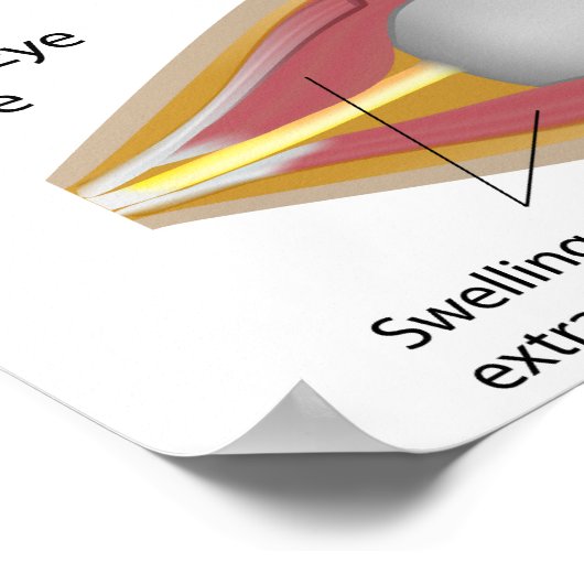 Schilddrüsenaugenerkrankung Poster (Ecke)