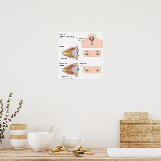 Schilddrüsenaugenerkrankung Poster (Küche)