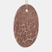 Schilddrüsezellen mit Krebs Keramikornament (Rechts)