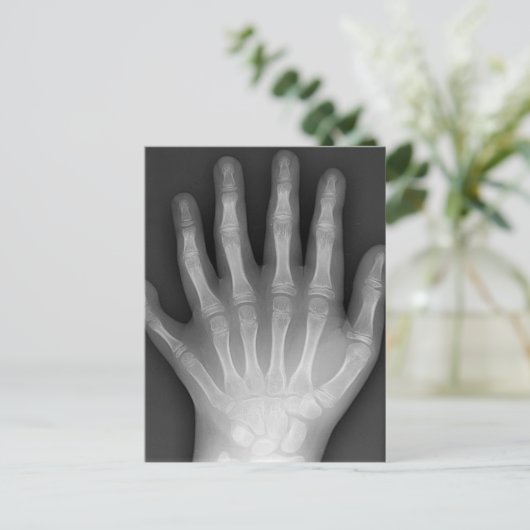 Sechs fingrige Hand, medizinische Rarität, Postkarte (Stehend Vorderseite)
