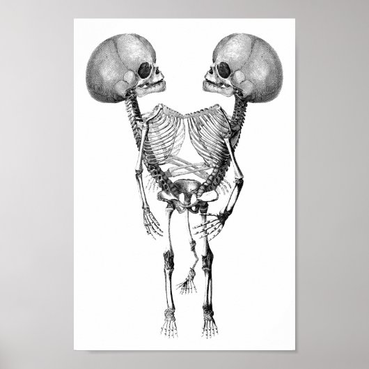 Siamesisch verbunden Twins Anatomie Skeletton Kuns Poster (Vorne)