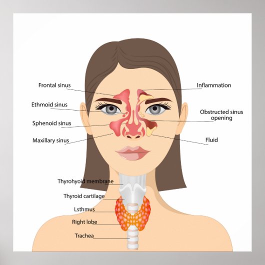 Sinusitis Poster (Vorne)
