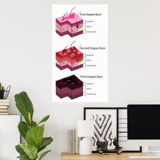 Skin Brennen Erste und Dritte Stufe Diagramm Poster (Heimbüro)