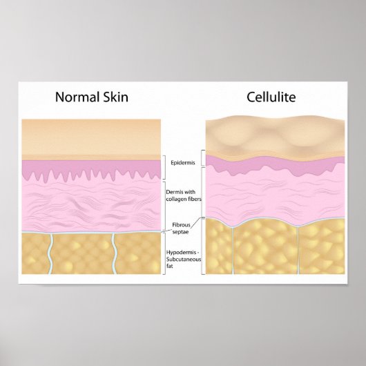 Skin Cellulite Poster (Vorne)