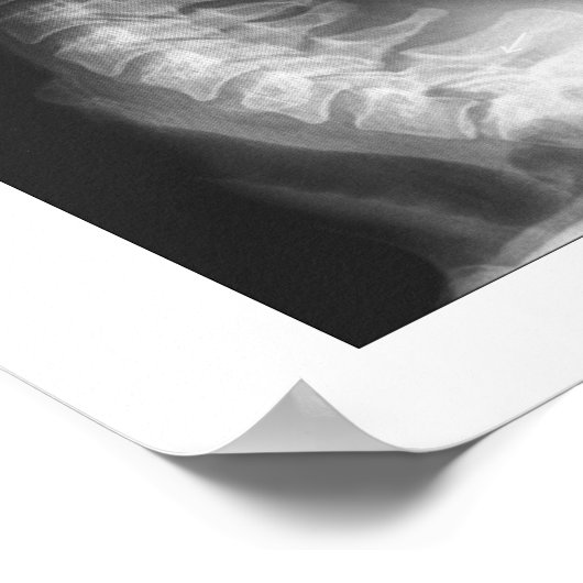 Spanischer Unterluxation Zervikalspinale Entkernun Poster (Ecke)