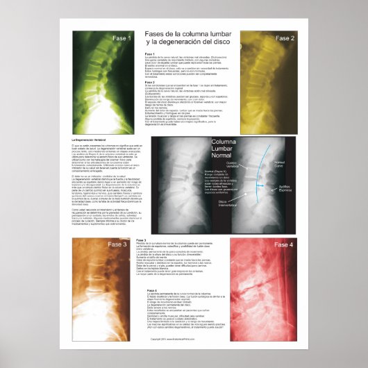 Spanisches Phases Lumbar Spinal Degenerations Post Poster (Vorne)