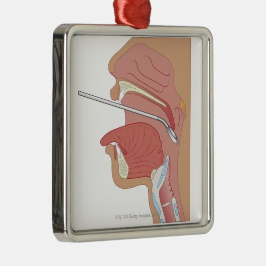 SpiegelLaryngoscopy Silbernes Ornament (Rechts)