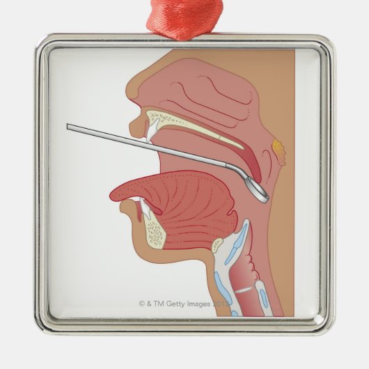 SpiegelLaryngoscopy Silbernes Ornament (Vorne)