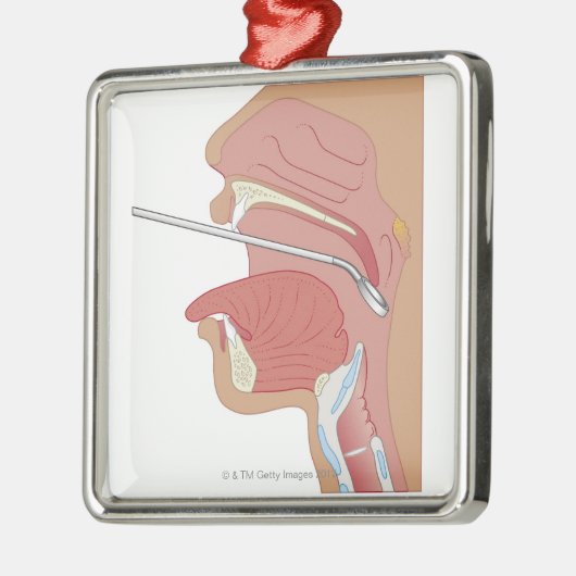 SpiegelLaryngoscopy Silbernes Ornament (Links)