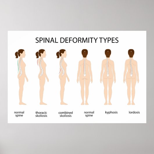 Spinal-Deformationstypen Poster (Vorne)