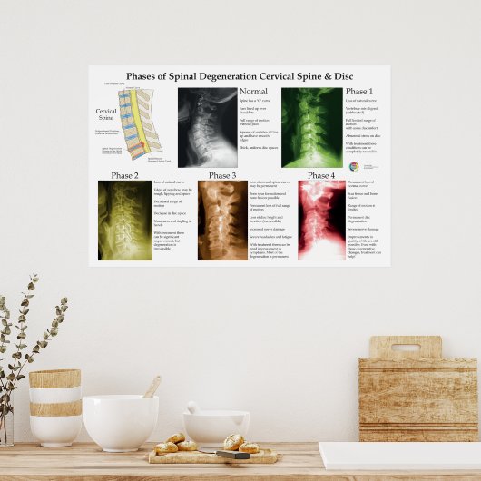 Spinal Degeneration Cervical Spine Chiropractic Poster (Küche)