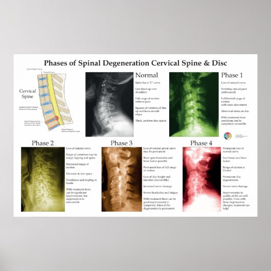Spinal Degeneration Cervical Spine Chiropractic Poster (Vorne)