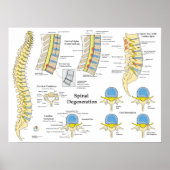 Spinal Degeneration Disk Herniation Poster (Vorne)