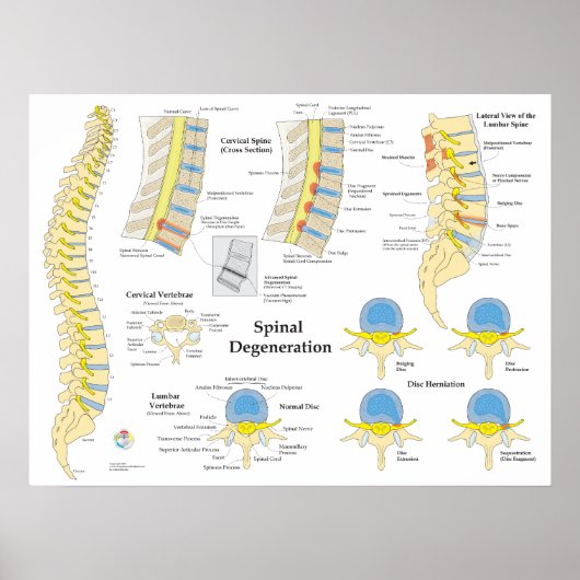 Spinal Degeneration Disk Herniation Poster (Vorne)